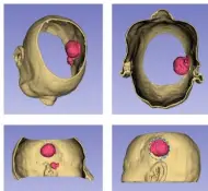 3D打印技术1:1还原人脑，二一五医院神经外科医生实现“先演练，再开刀”！