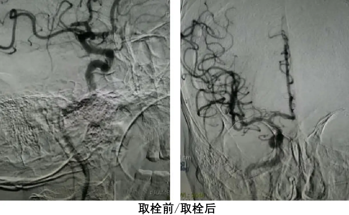 通用环球中铁西安医院精准取栓救治急性脑梗患者