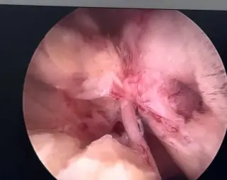 咸阳彩虹医院耳鼻咽喉科成功开展咸阳市首例视频耳内镜下“完壁式乳突根治术”