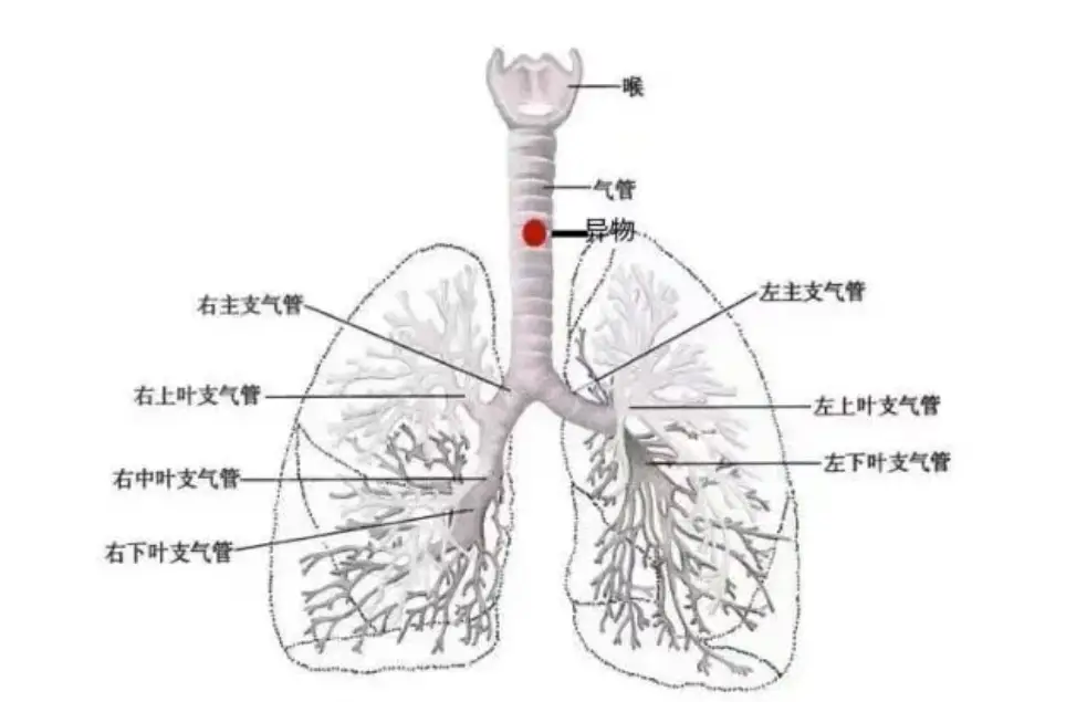 咸阳一院：咬断的“1cm”塑料吸管误吸入气管！差点酿成大祸 