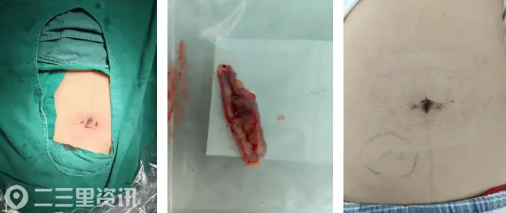 肚脐“无痕”除病痛！11岁阑尾炎患儿单孔手术，3天顺利康复出院