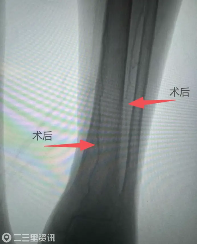 凌晨1点，98岁老人左腿濒临坏死！血管介入科6小时极限保肢