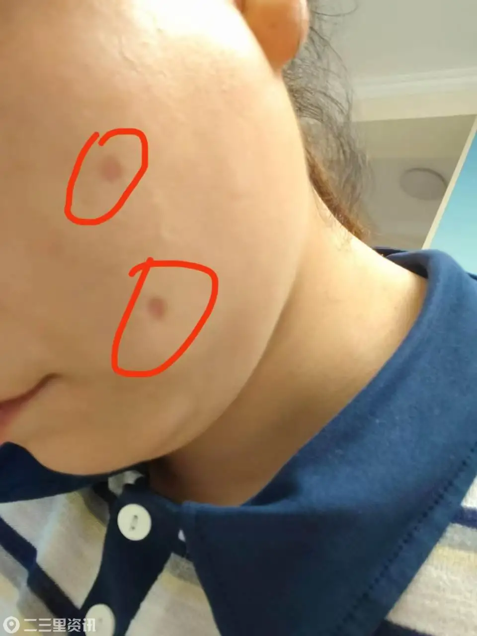 女子称点痣灼烧面部留疤红肿，投诉养生店为“生活美容”资质 ；卫监部门：无法认定医美，损伤只是结果，而非损伤性操作