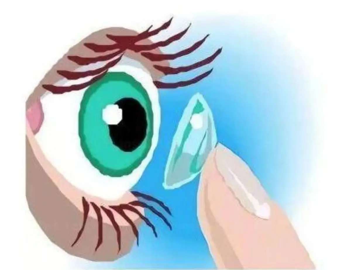 西安市第一医院：眼视光中心在国际期刊《Contact Lens &Anterior Eye》发表论文