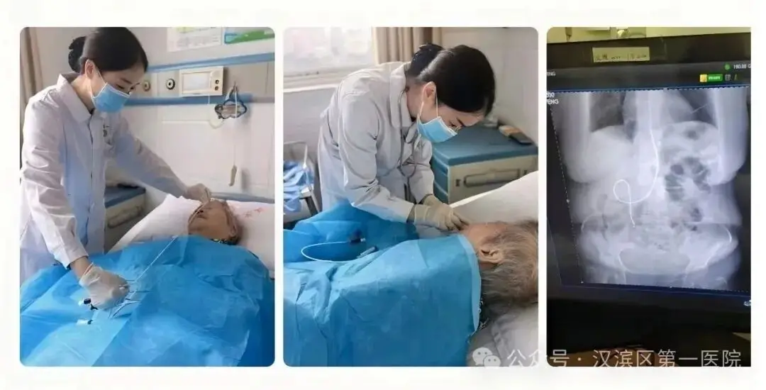开辟生命营养通道！汉滨区第一医院完成首例床旁盲插鼻肠营养管置入术