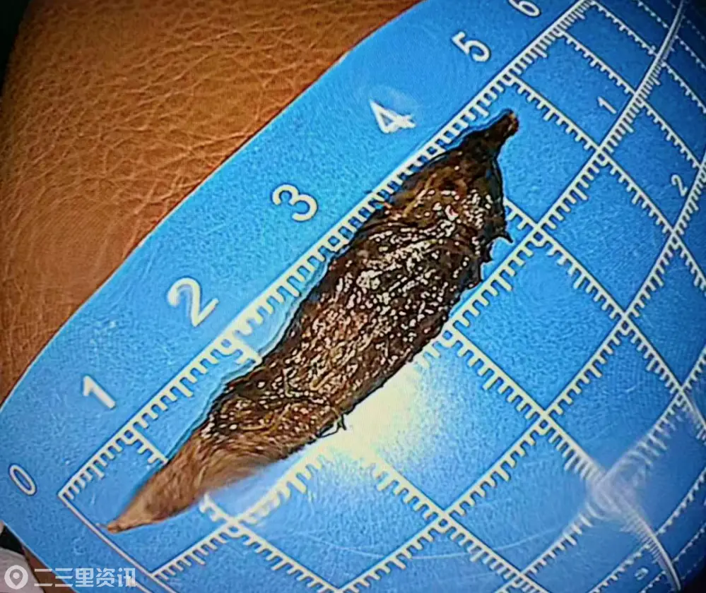 4.5厘米枣核“卡”住94岁老人 西安市第九医院深夜内镜“拆弹”化险为夷