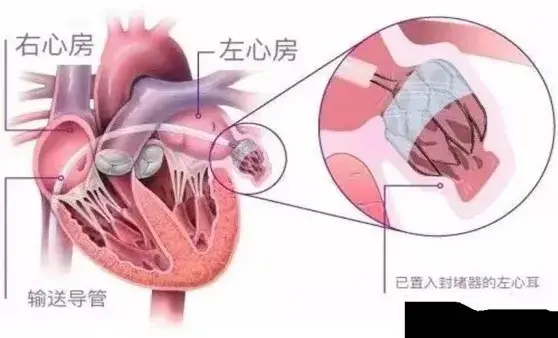 堵住心脏的“小耳朵” 预防脑梗大风险—一次手术解决两大难题